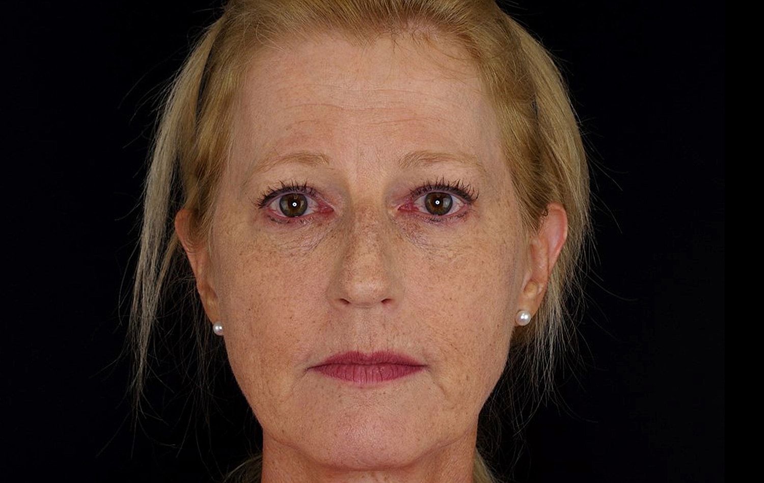 Rhinoplasty Before & After