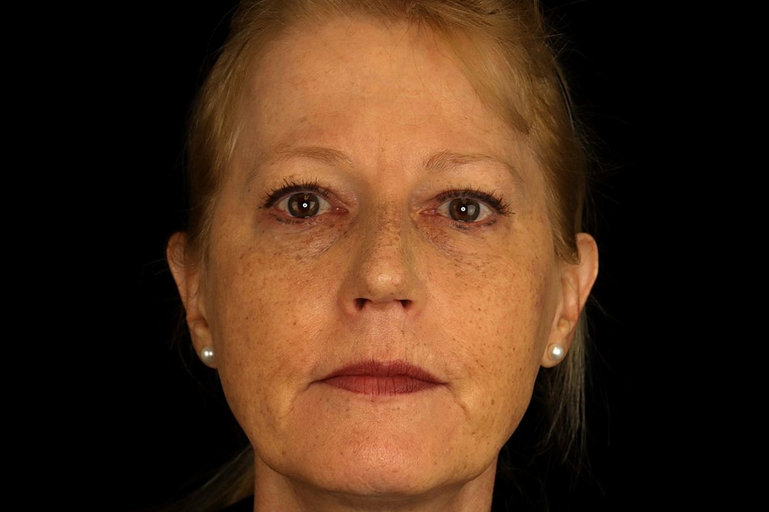 Rhinoplasty Before & After