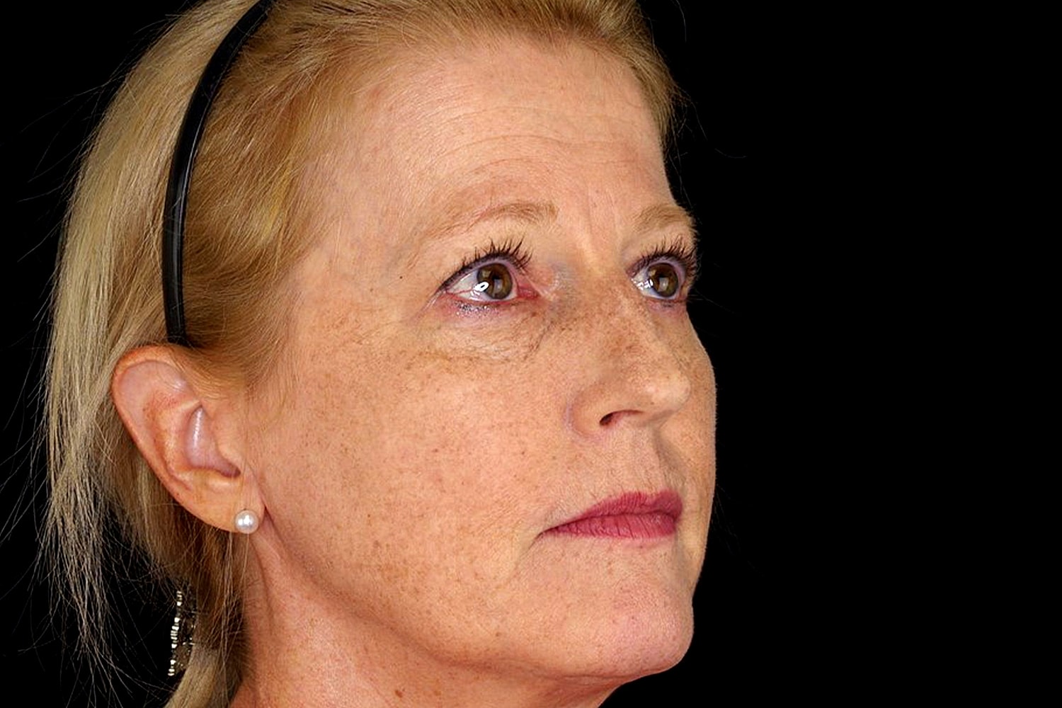 Rhinoplasty Before & After