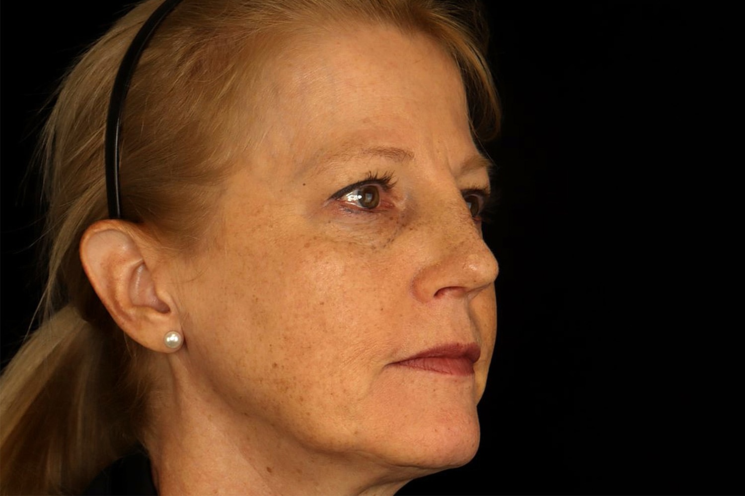 Rhinoplasty Before & After
