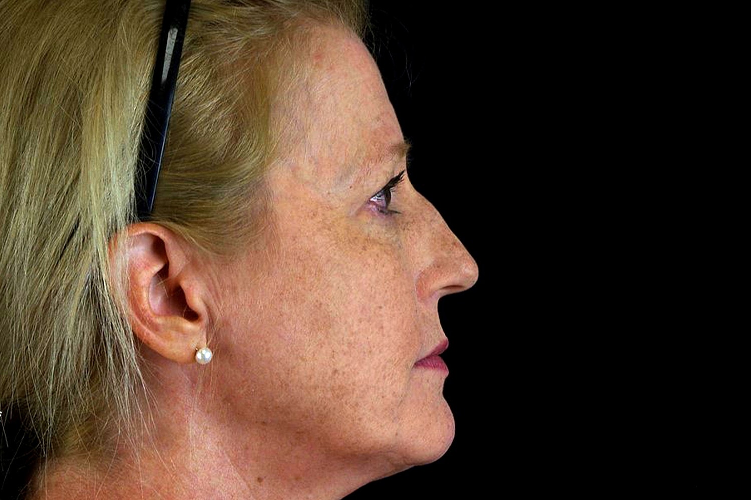 Rhinoplasty Before & After