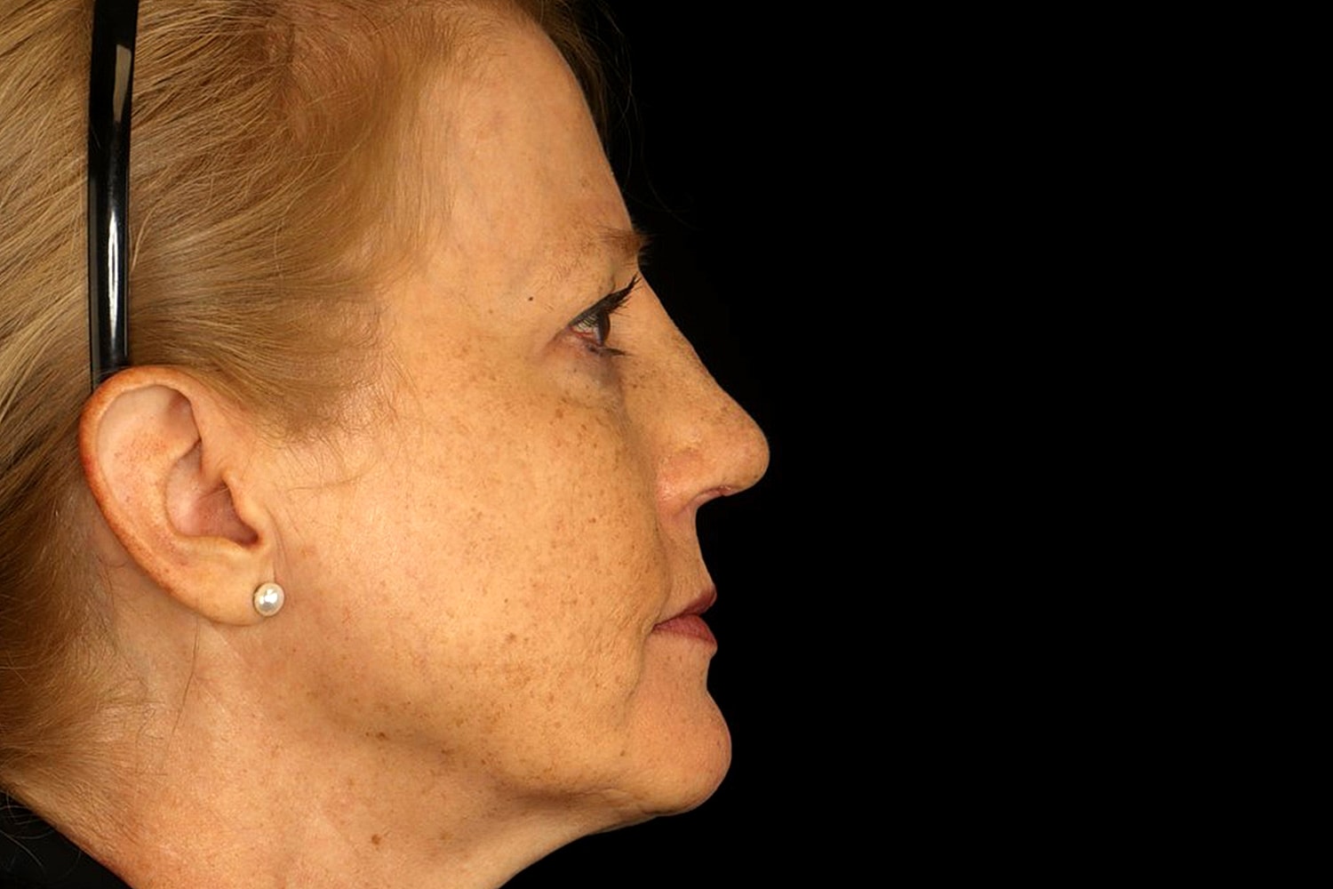 Rhinoplasty Before & After
