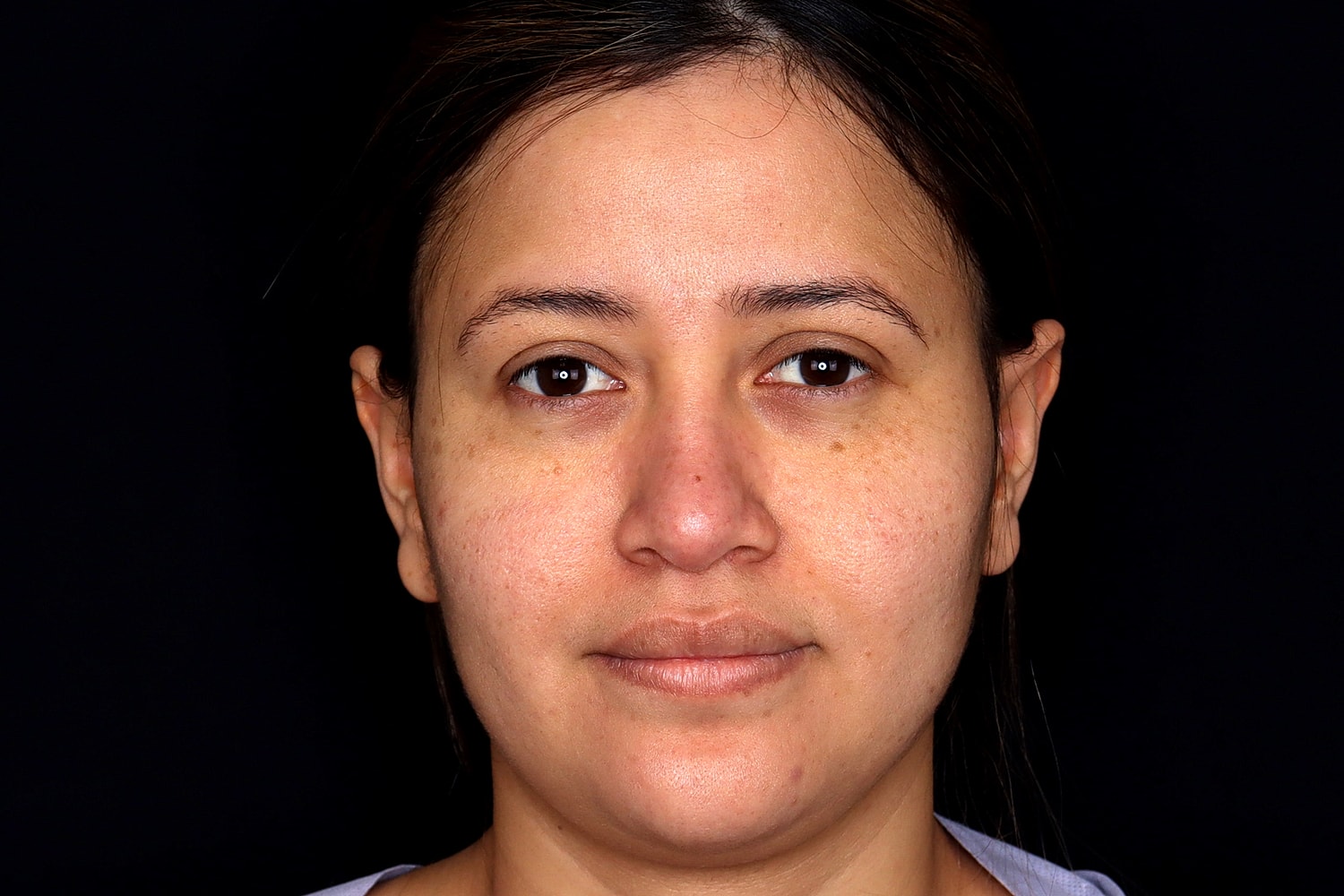 Rhinoplasty Before & After