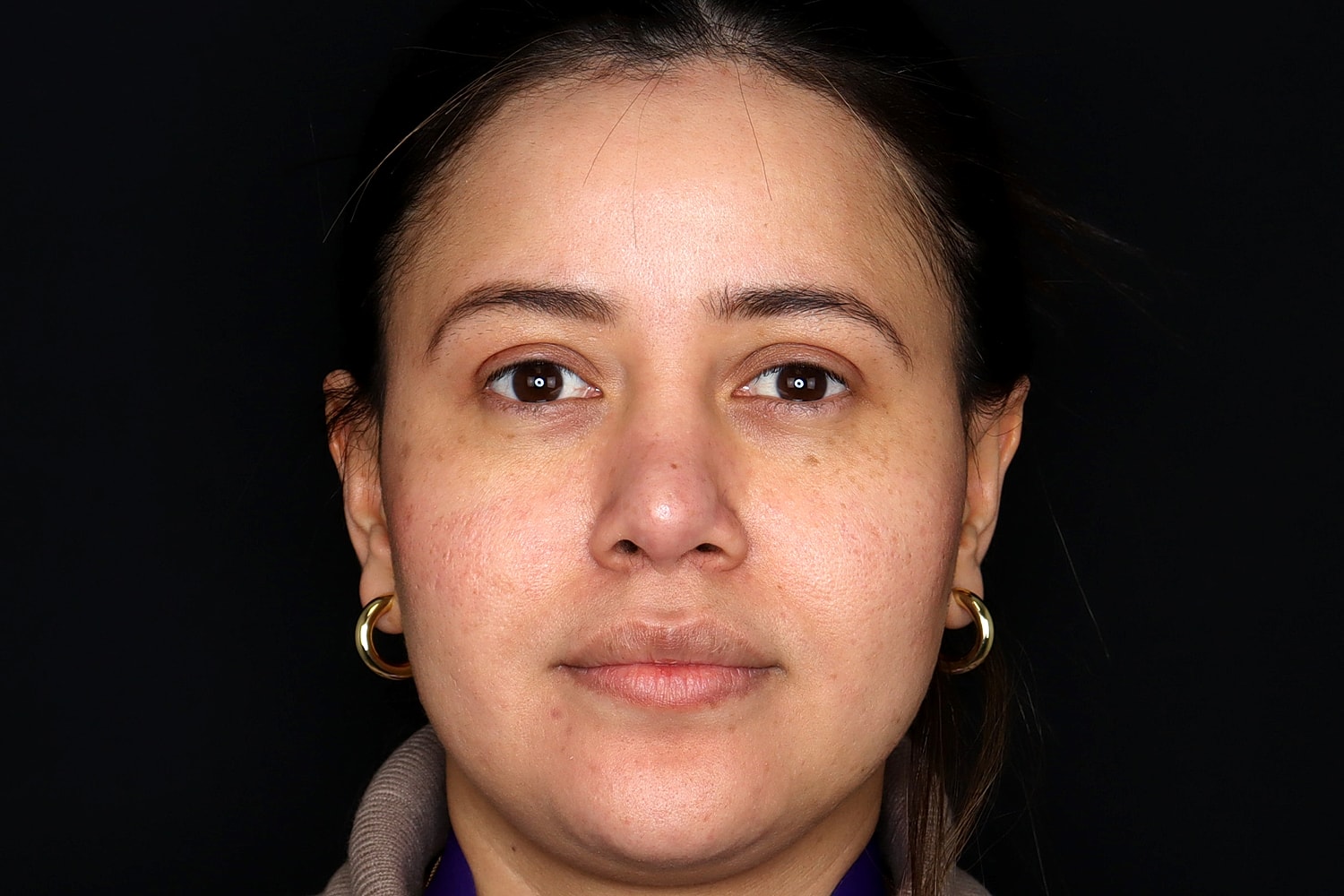 Rhinoplasty Before & After