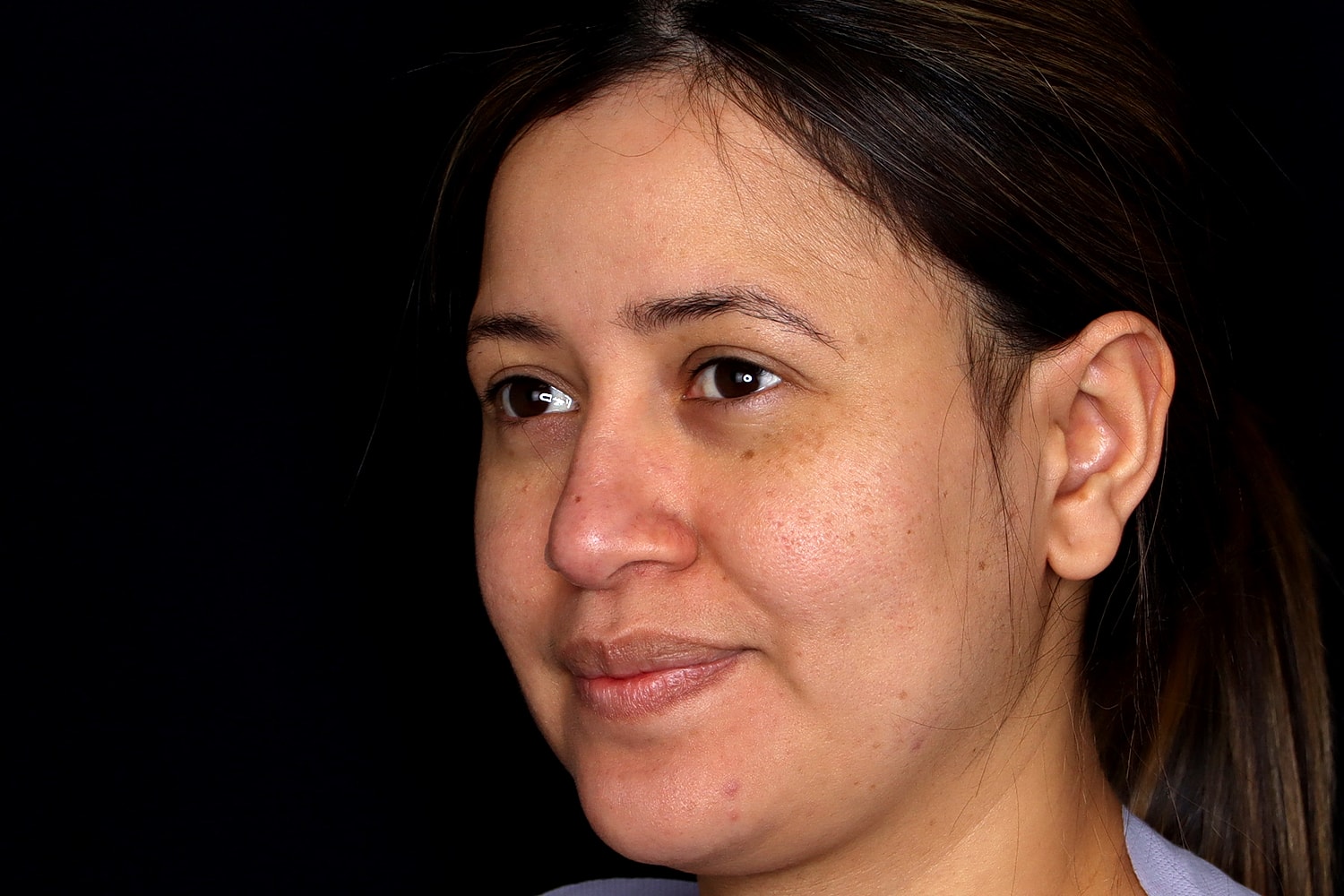 Rhinoplasty Before & After