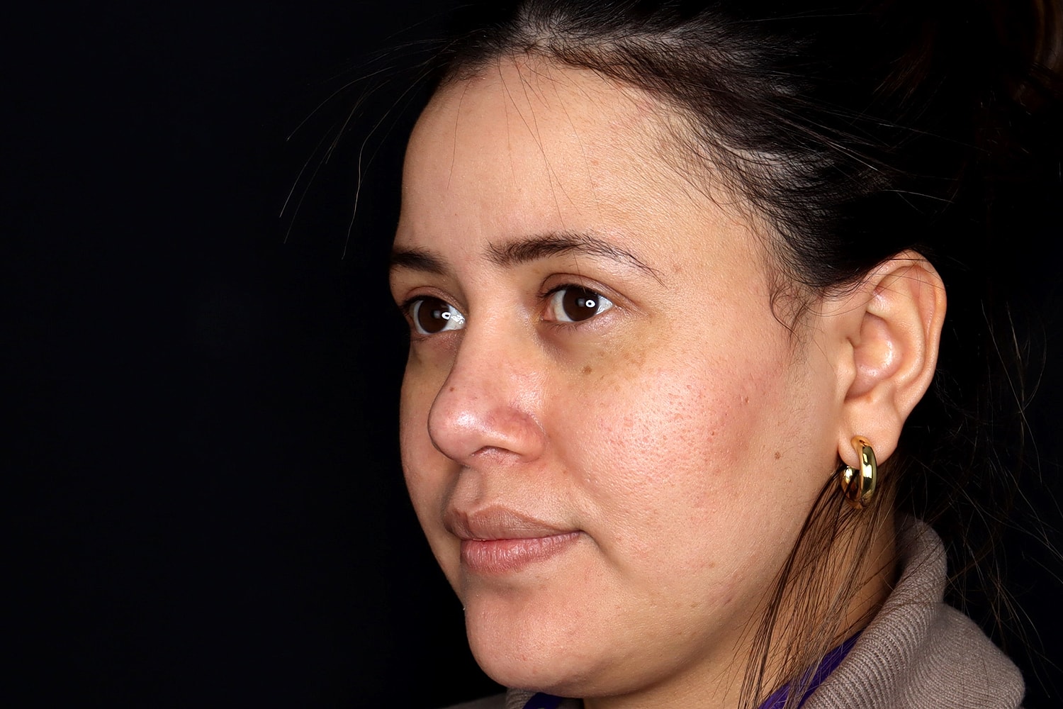 Rhinoplasty Before & After