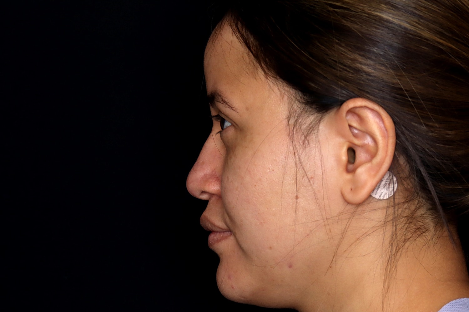 Rhinoplasty Before & After