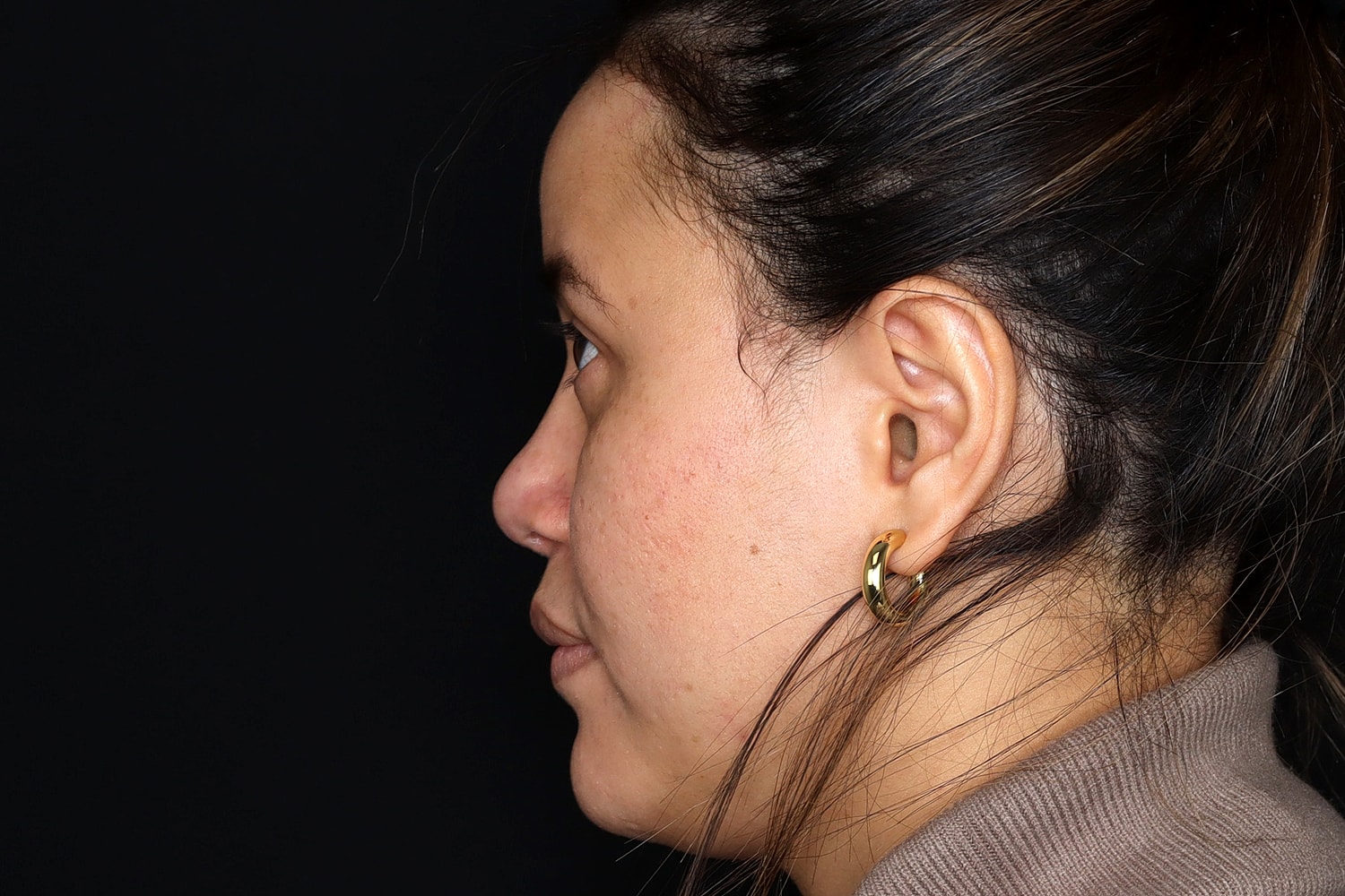 Rhinoplasty Before & After