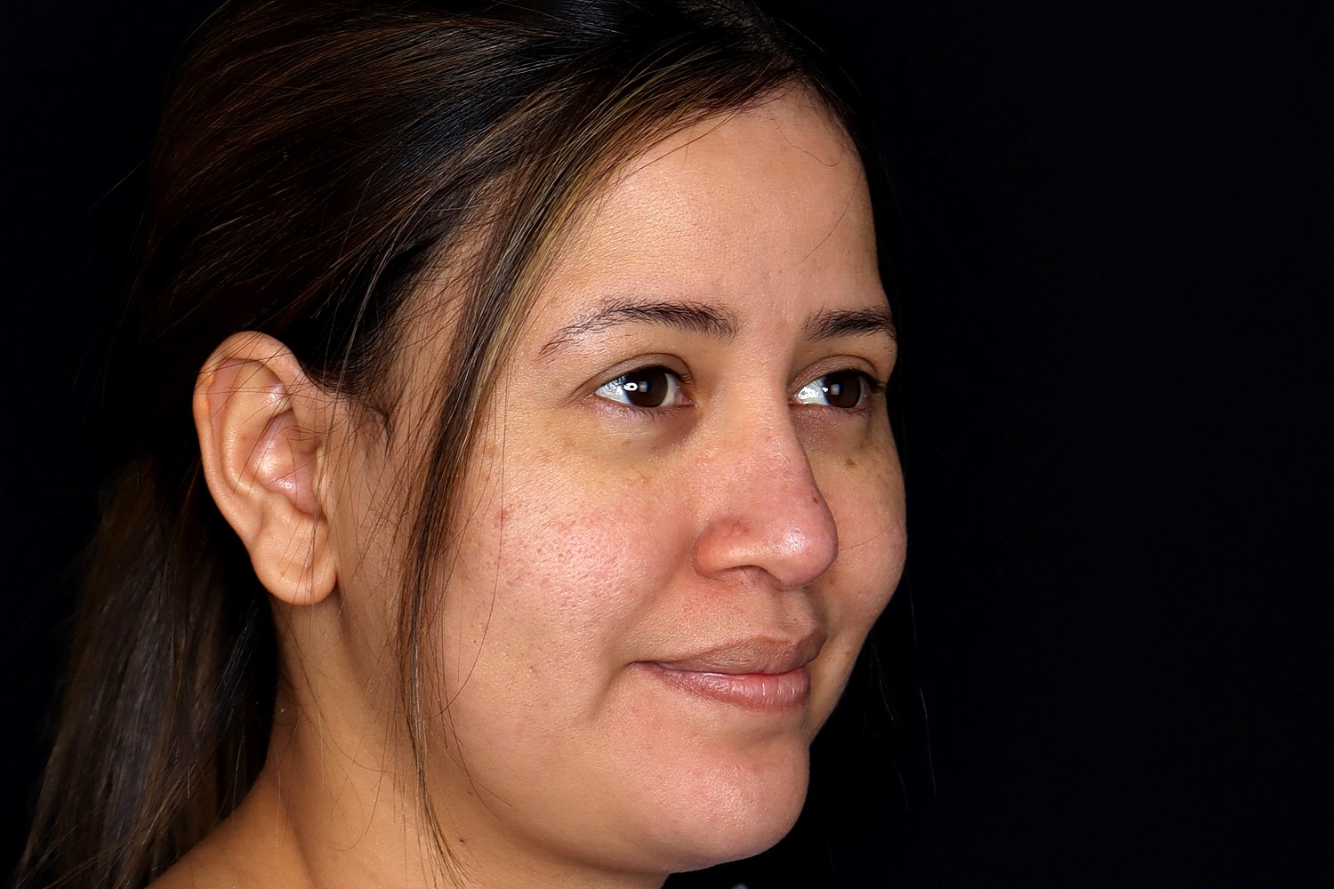 Rhinoplasty Before & After