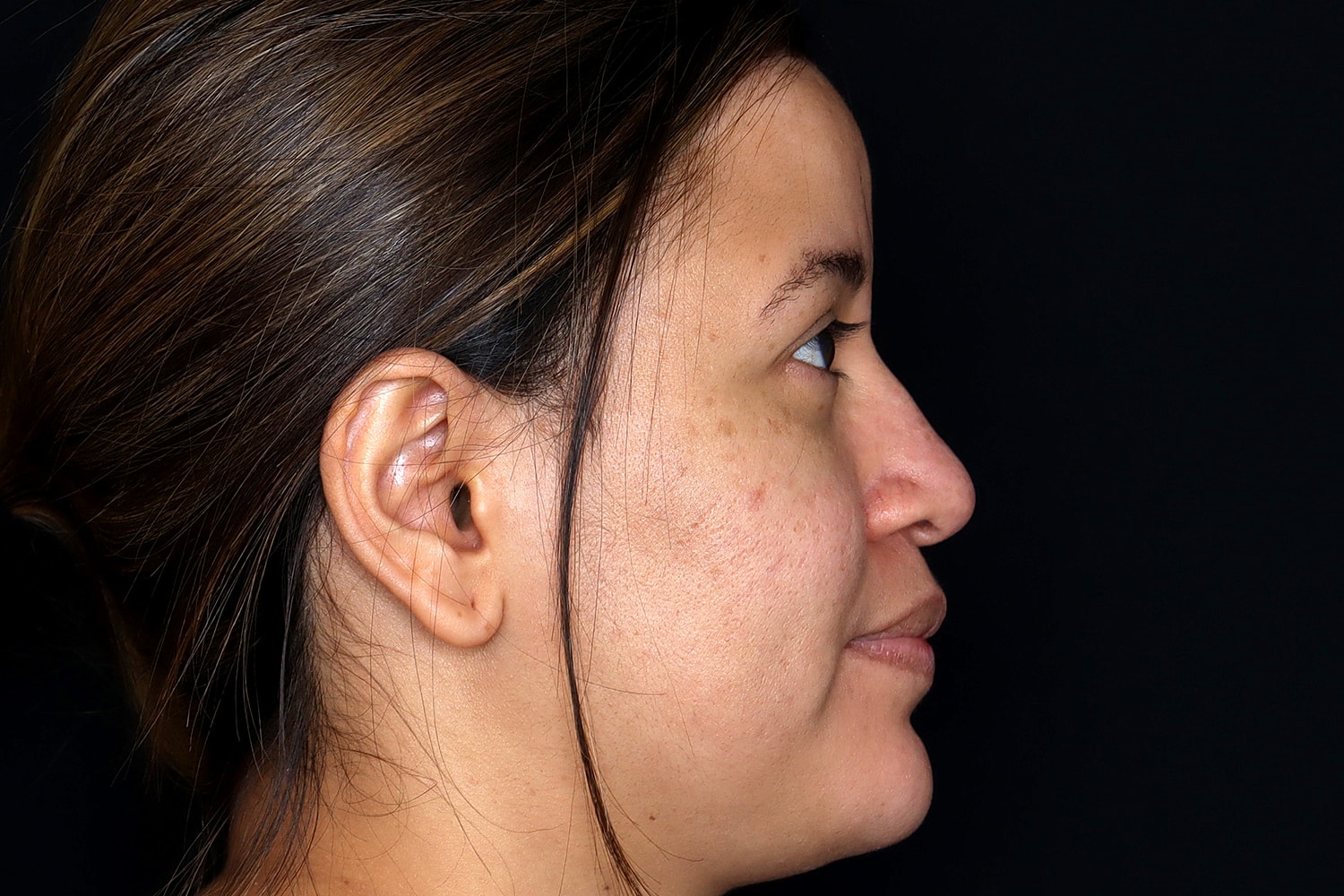 Rhinoplasty Before & After