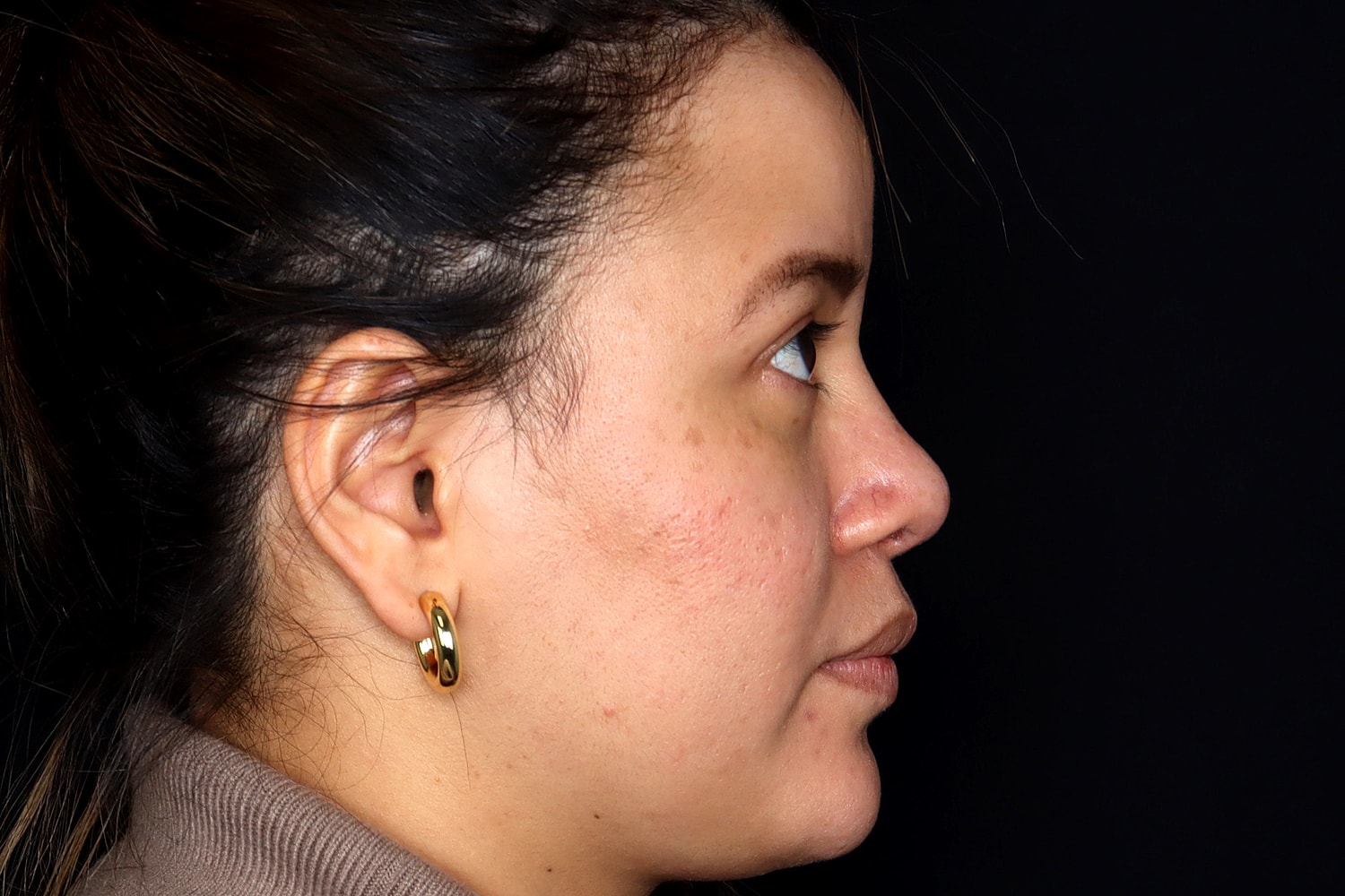 Rhinoplasty Before & After