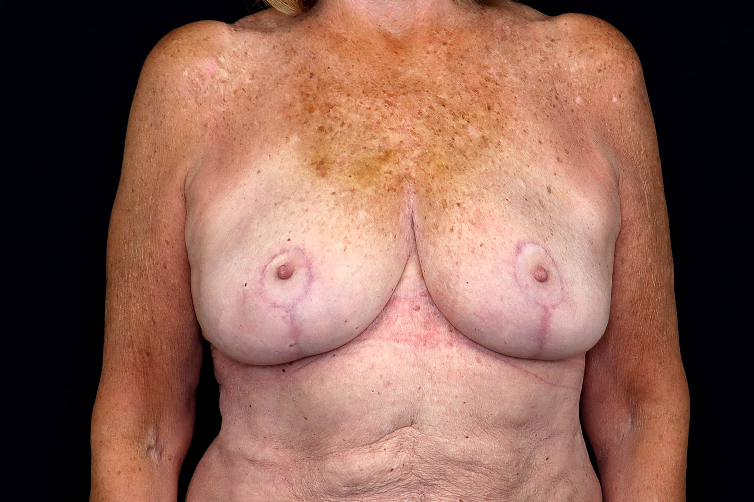 Breast Reduction Before & After