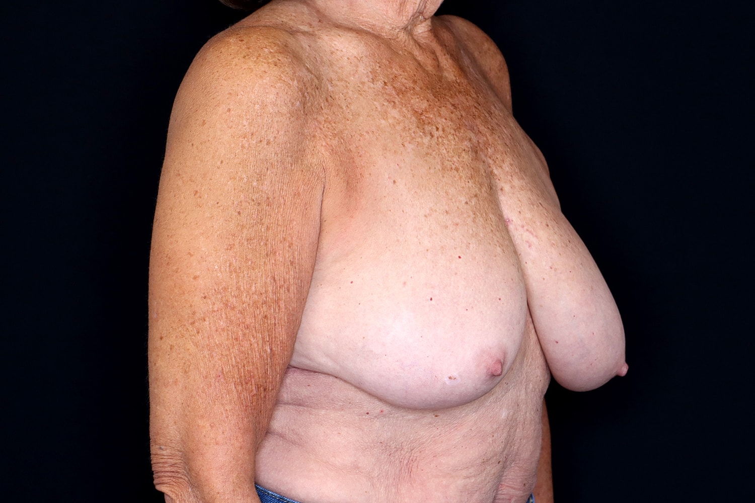 Breast Reduction Before & After
