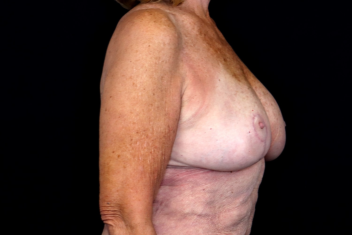Breast Reduction Before & After