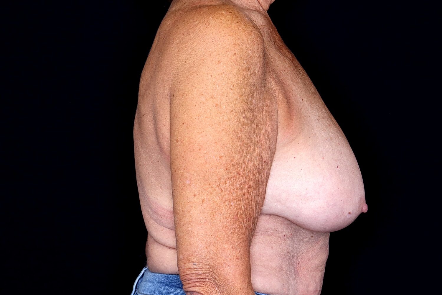Breast Reduction Before & After