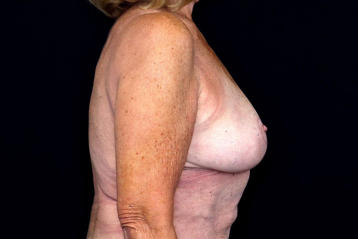 Breast Reduction Before & After