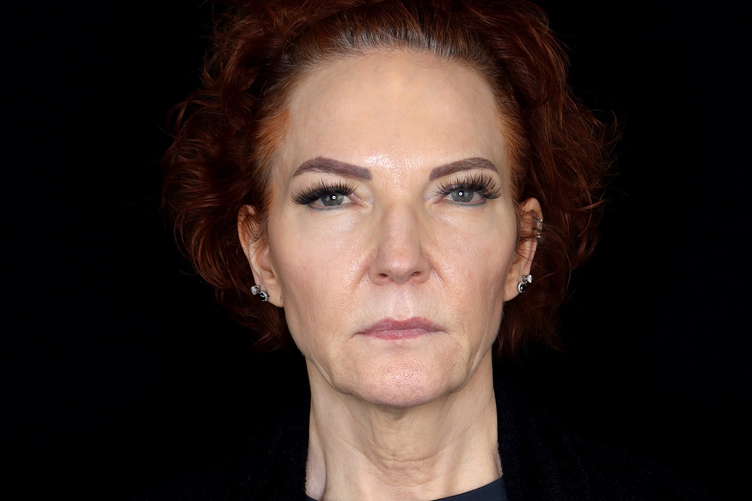 Facelift Before & After