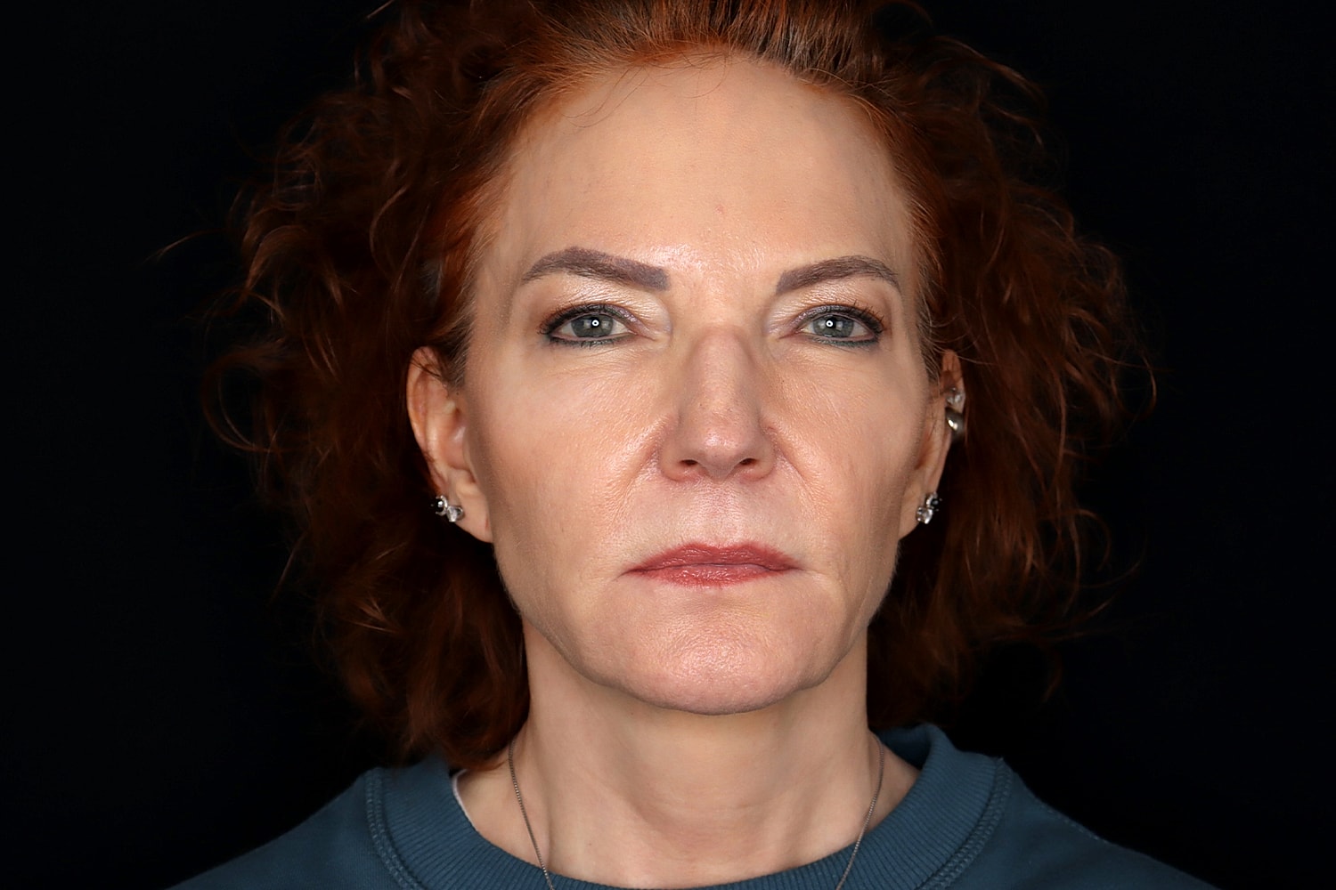Facelift Before & After