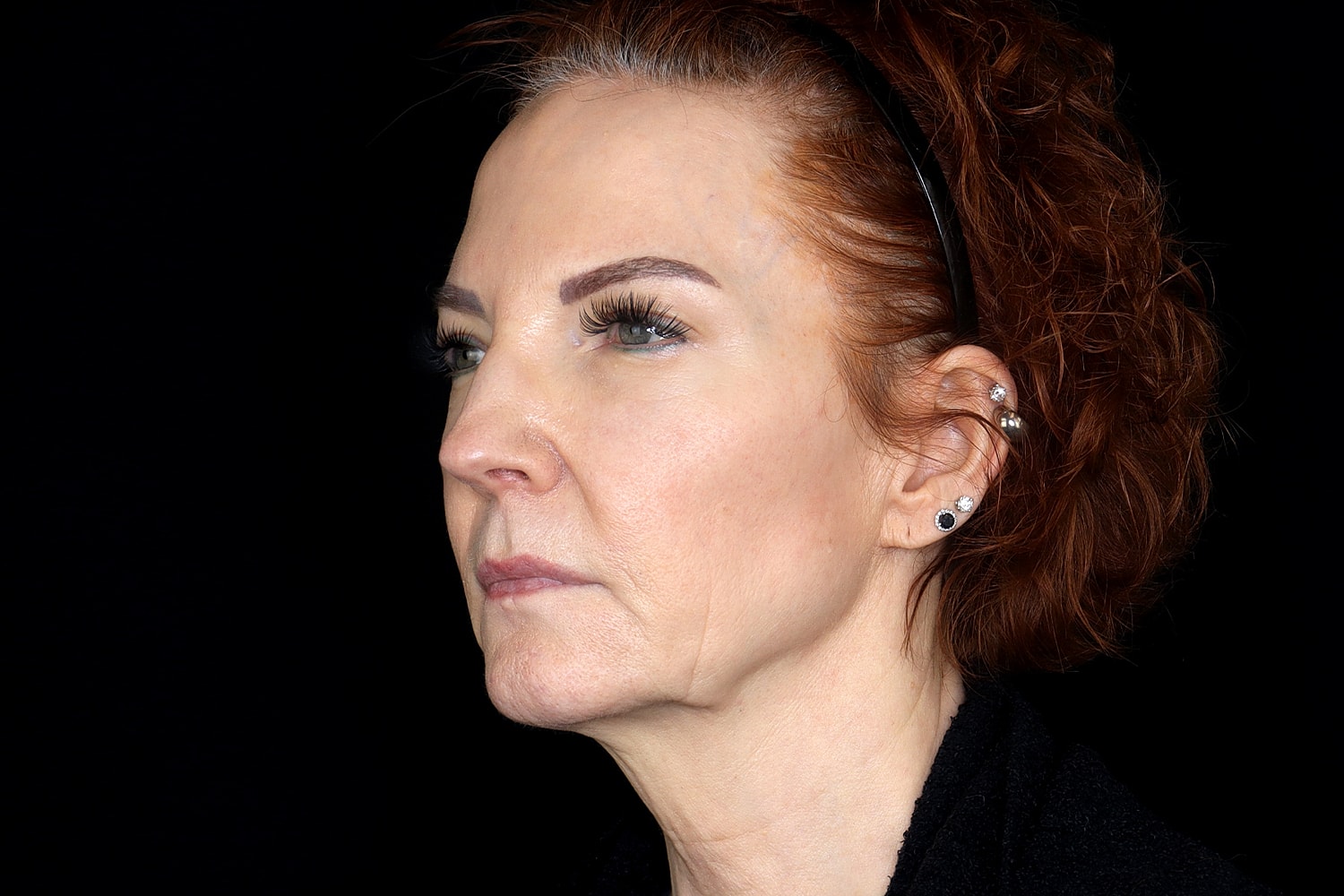 Facelift Before & After