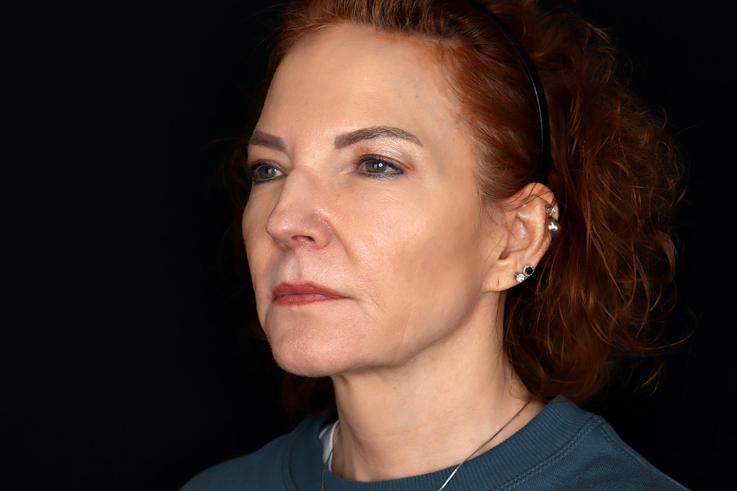 Facelift Before & After