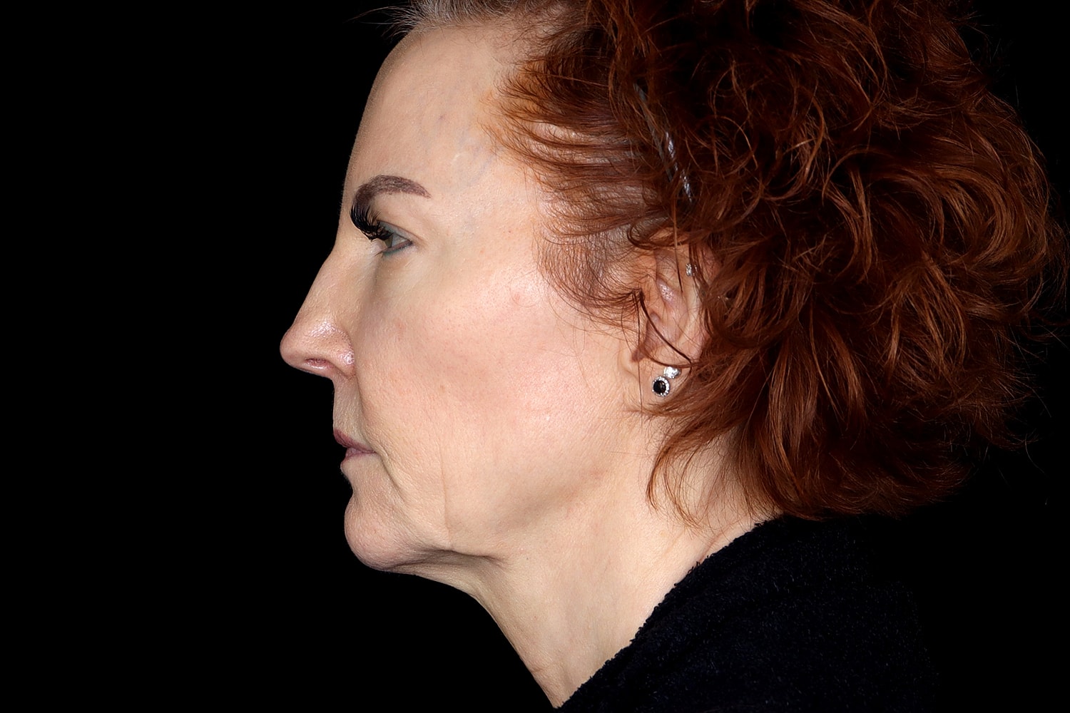 Facelift Before & After