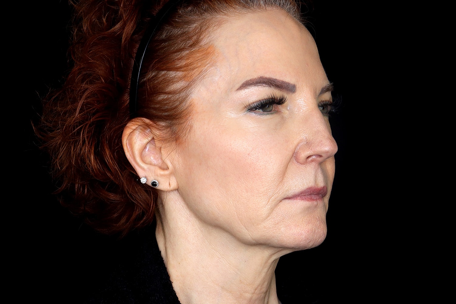 Facelift Before & After