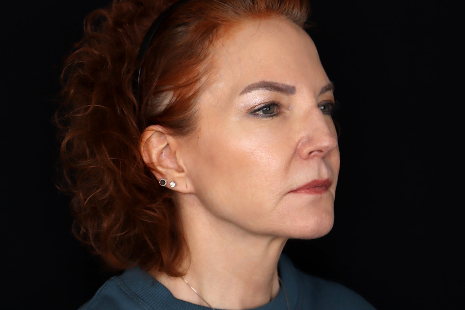 Facelift Before & After