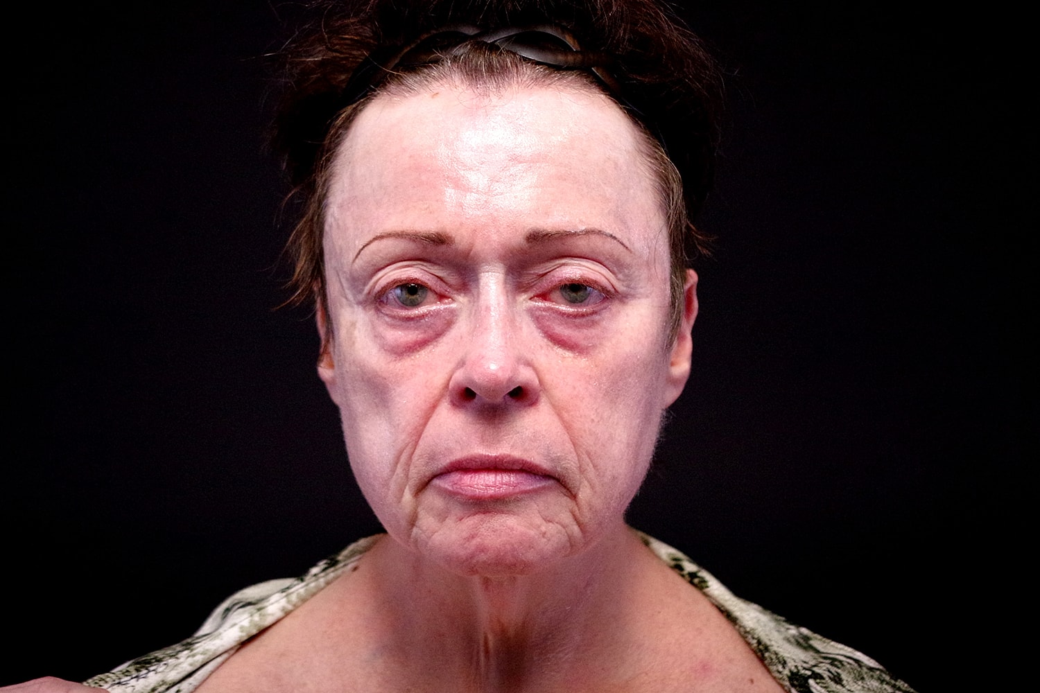 Facelift Before & After