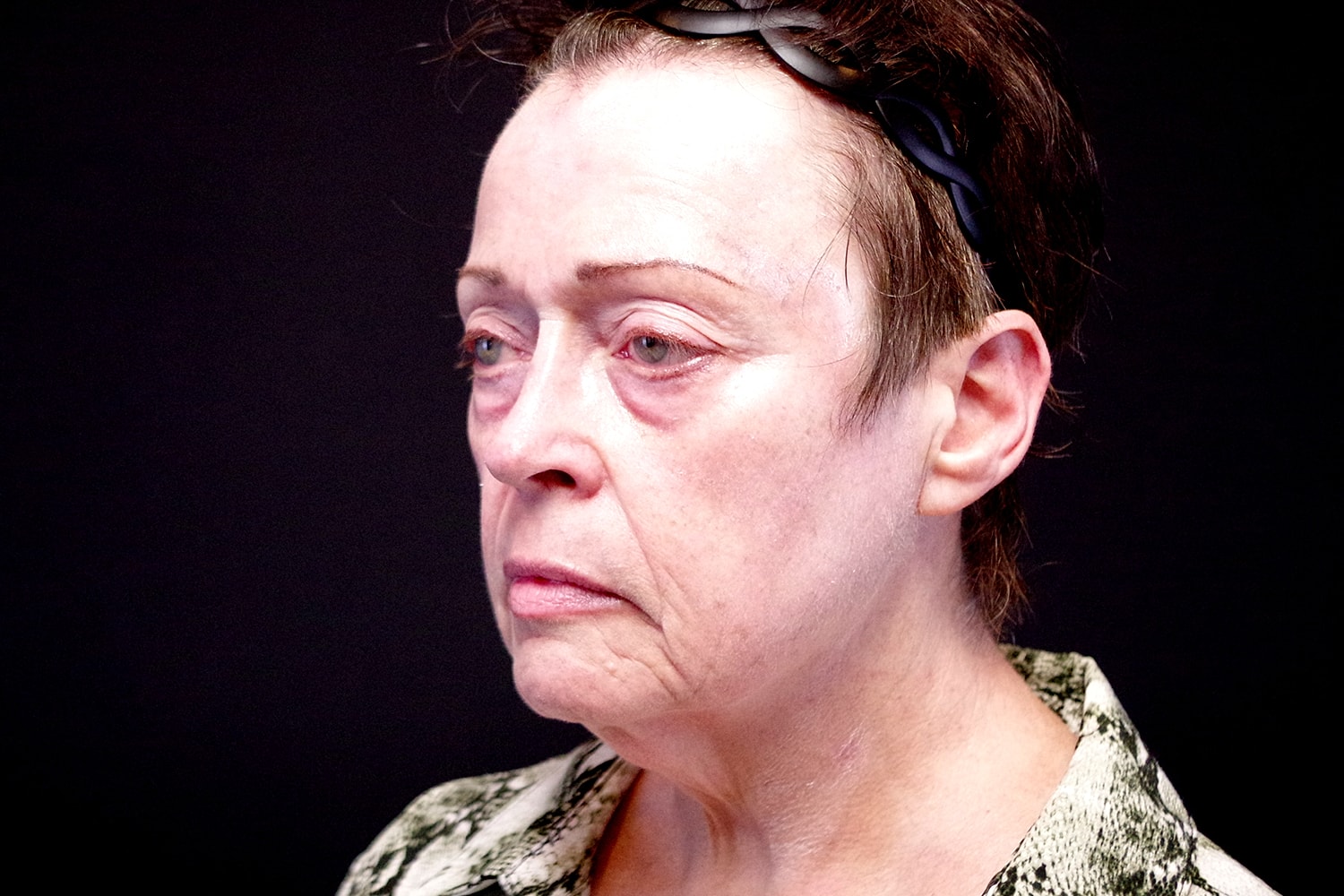 Facelift Before & After