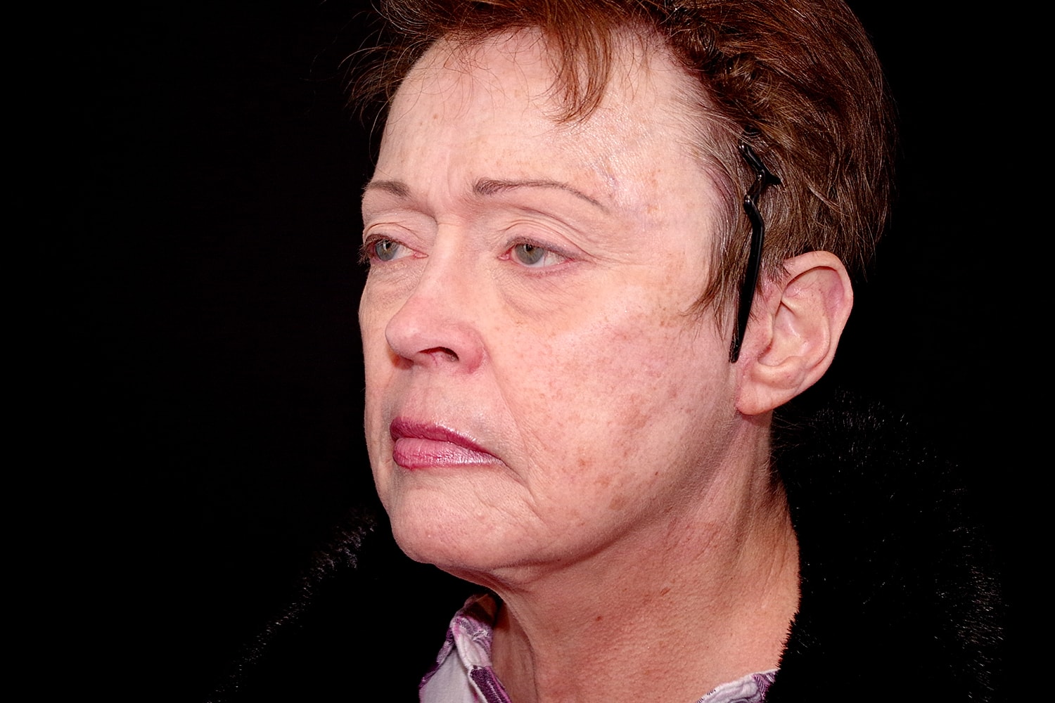 Facelift Before & After