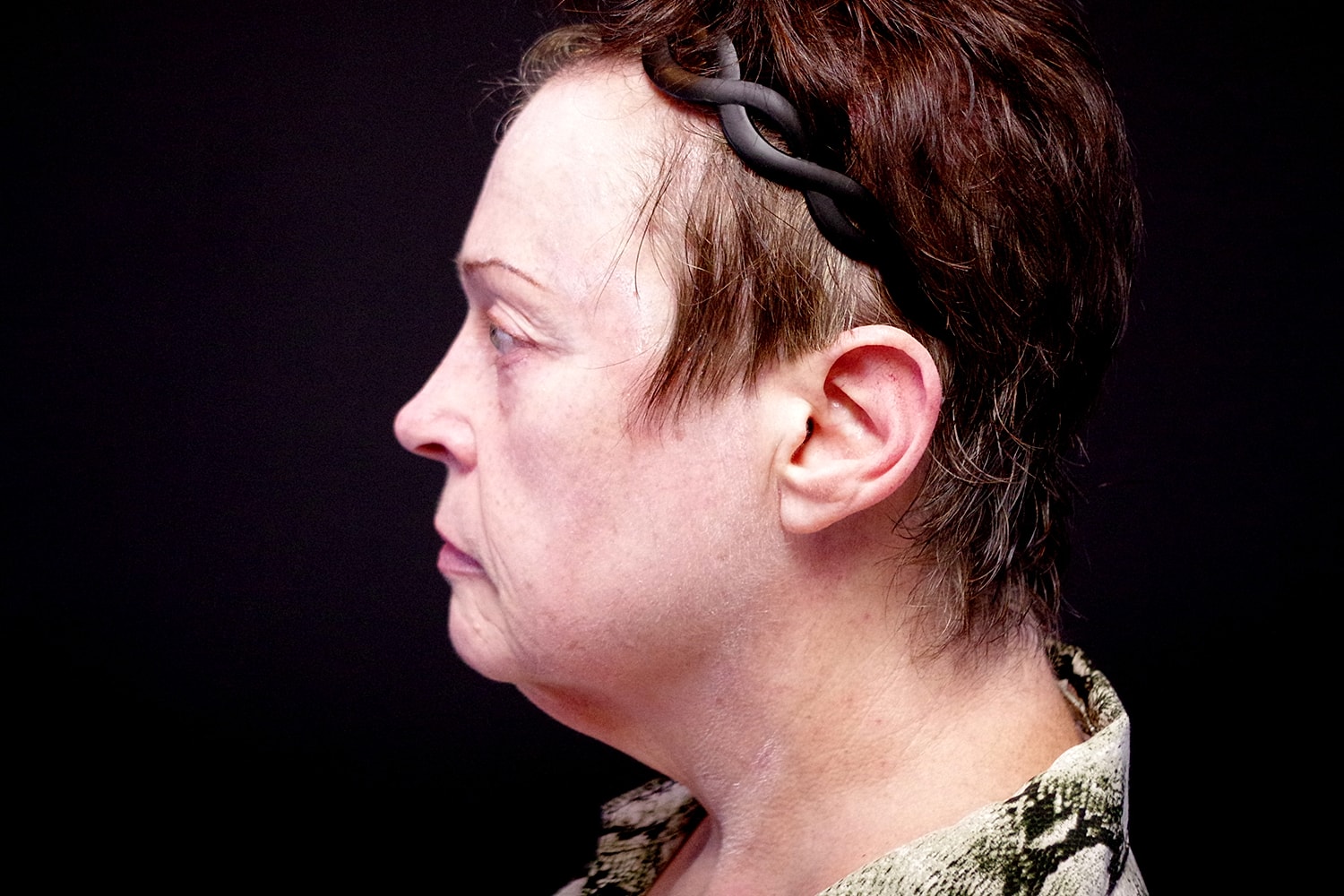 Facelift Before & After