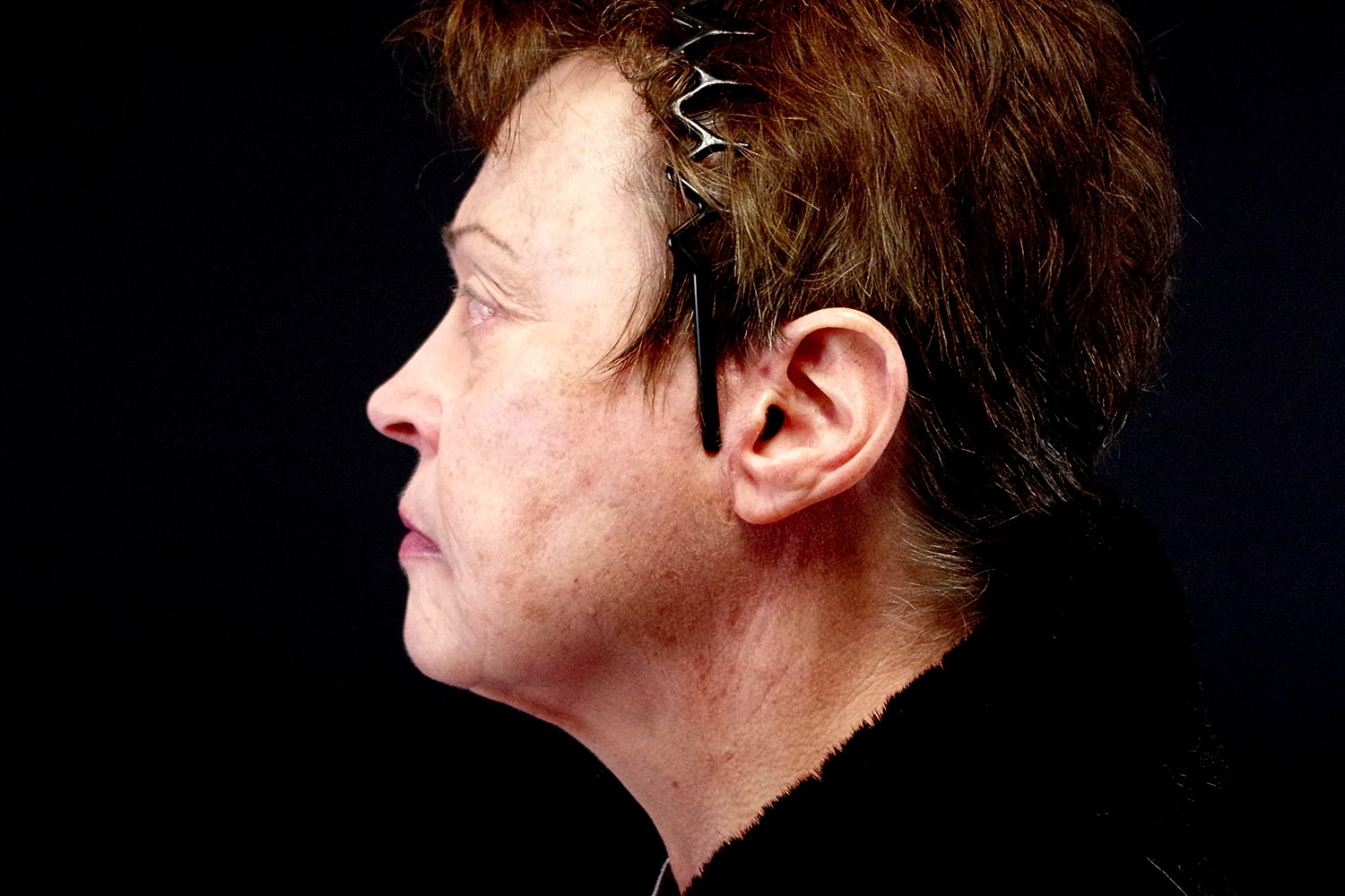 Facelift Before & After