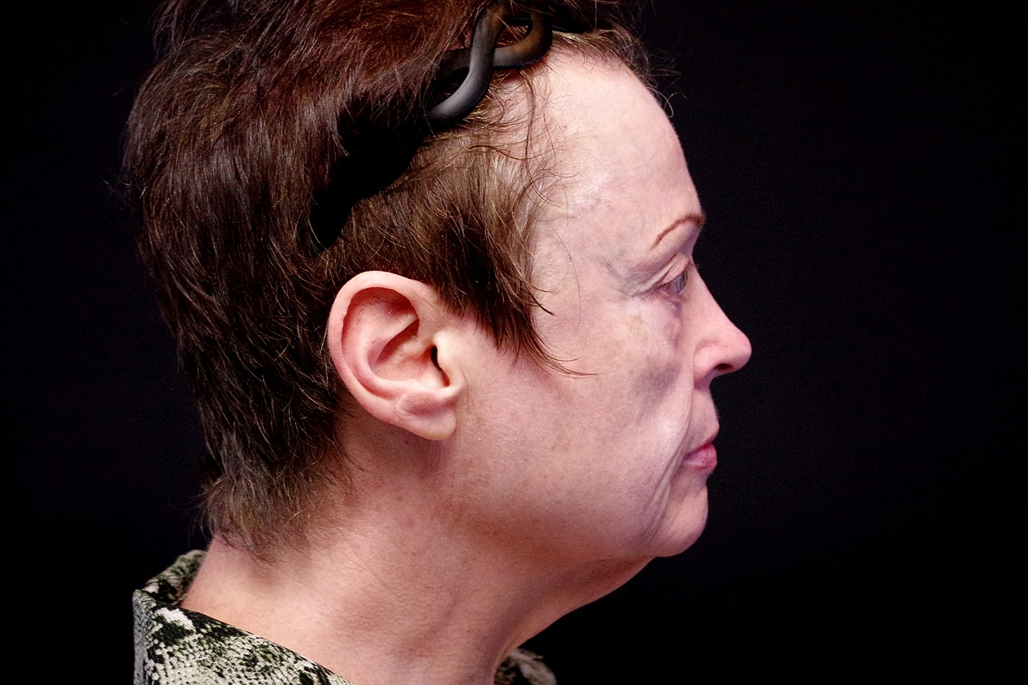 Facelift Before & After