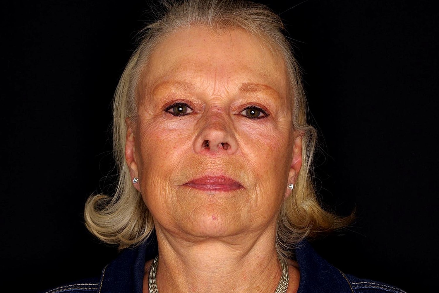 Facelift Before & After