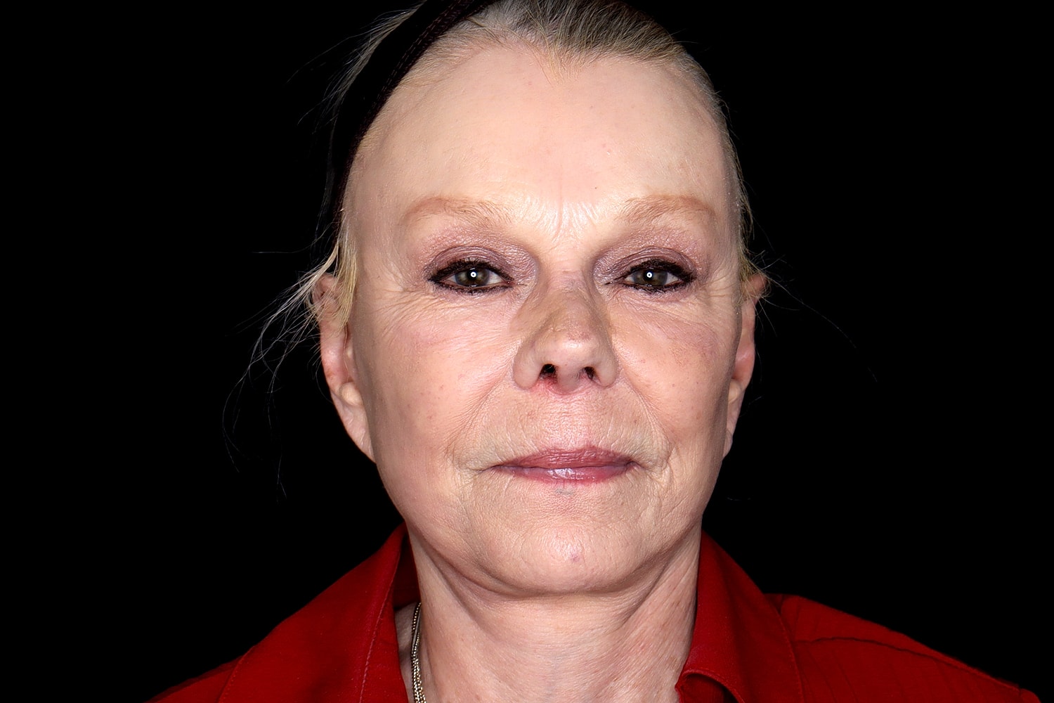 Facelift Before & After