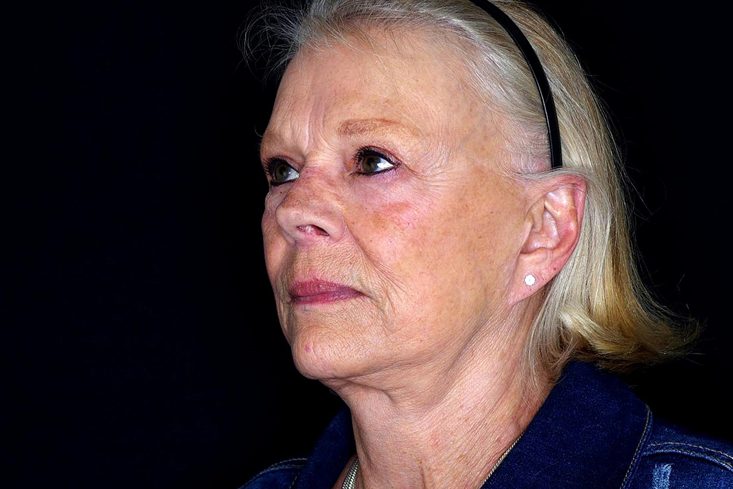 Facelift Before & After