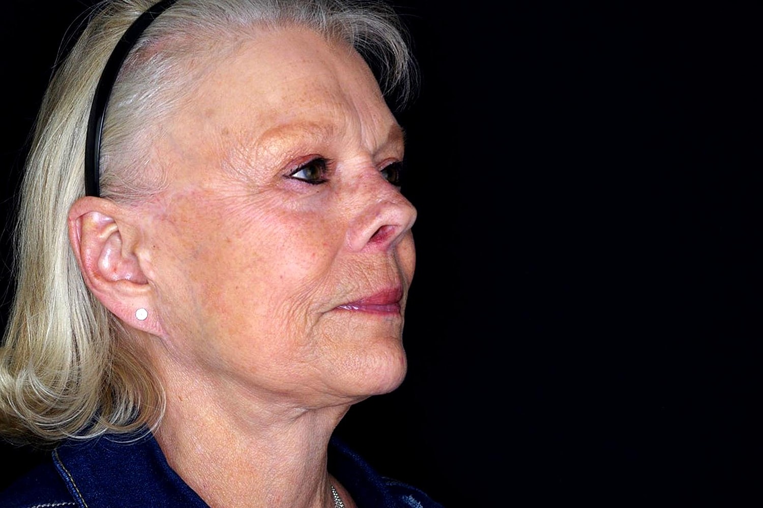 Facelift Before & After