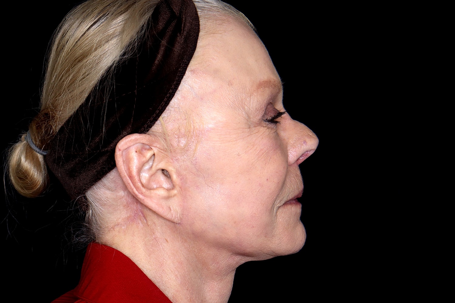 Facelift Before & After
