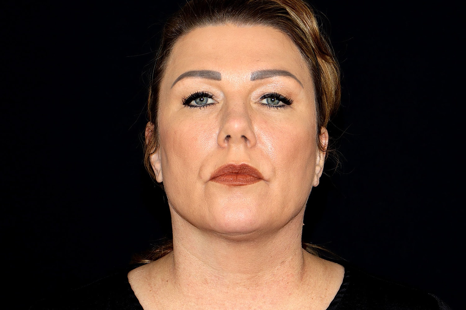 Facelift Before & After