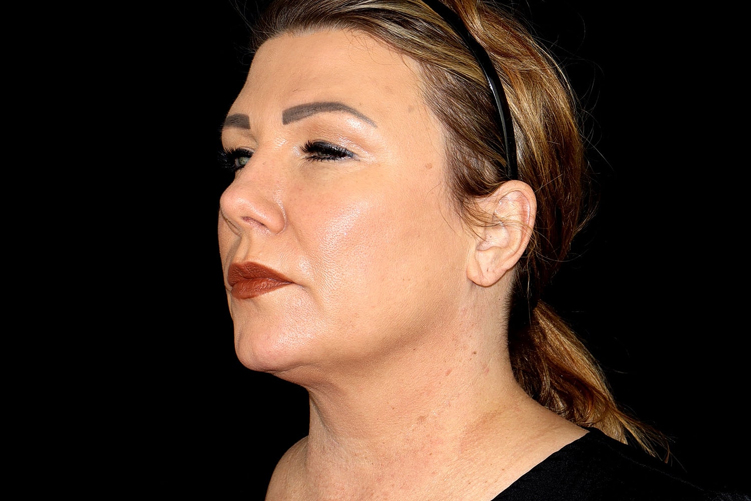 Facelift Before & After