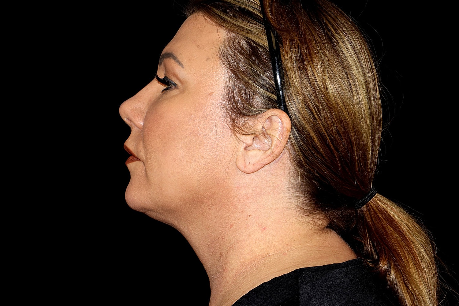 Facelift Before & After
