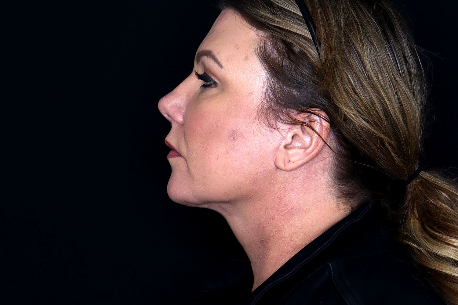 Facelift Before & After