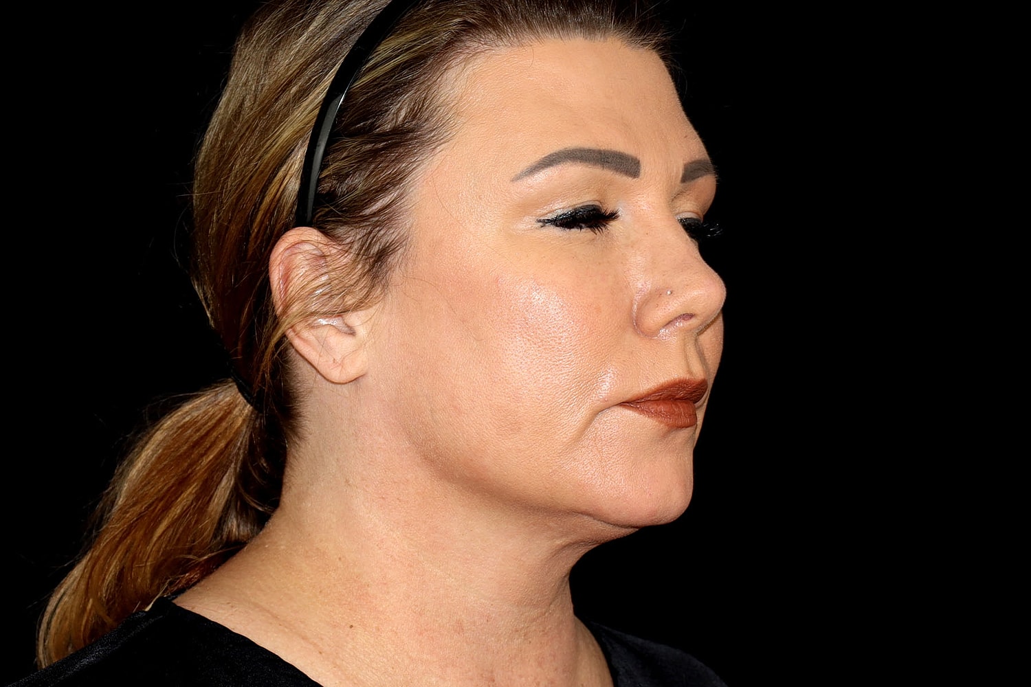 Facelift Before & After