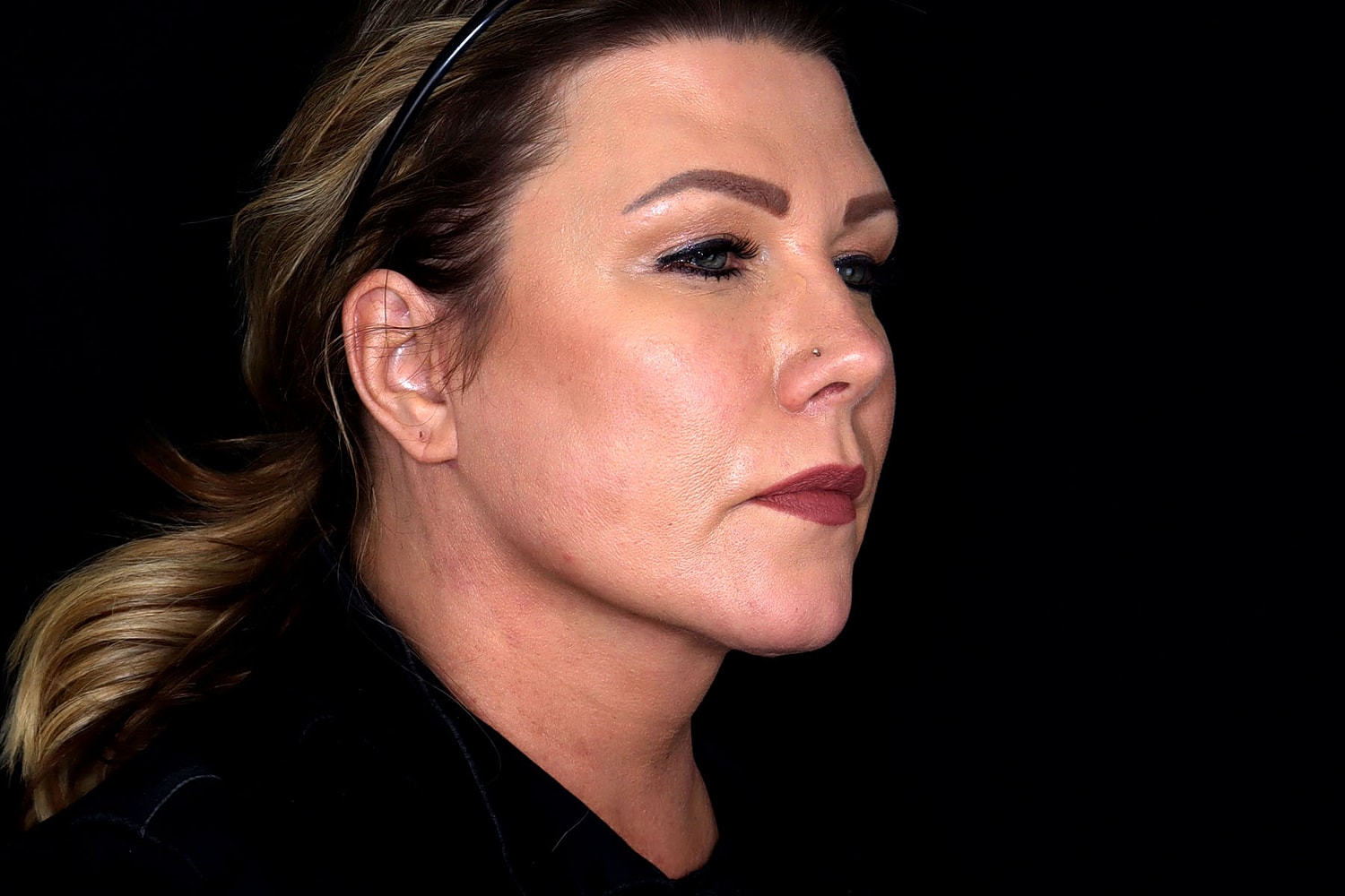 Facelift Before & After