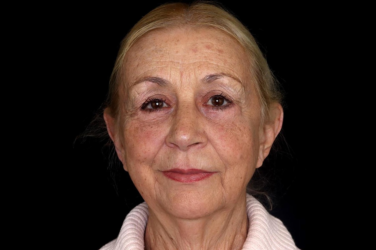 Facelift Before & After