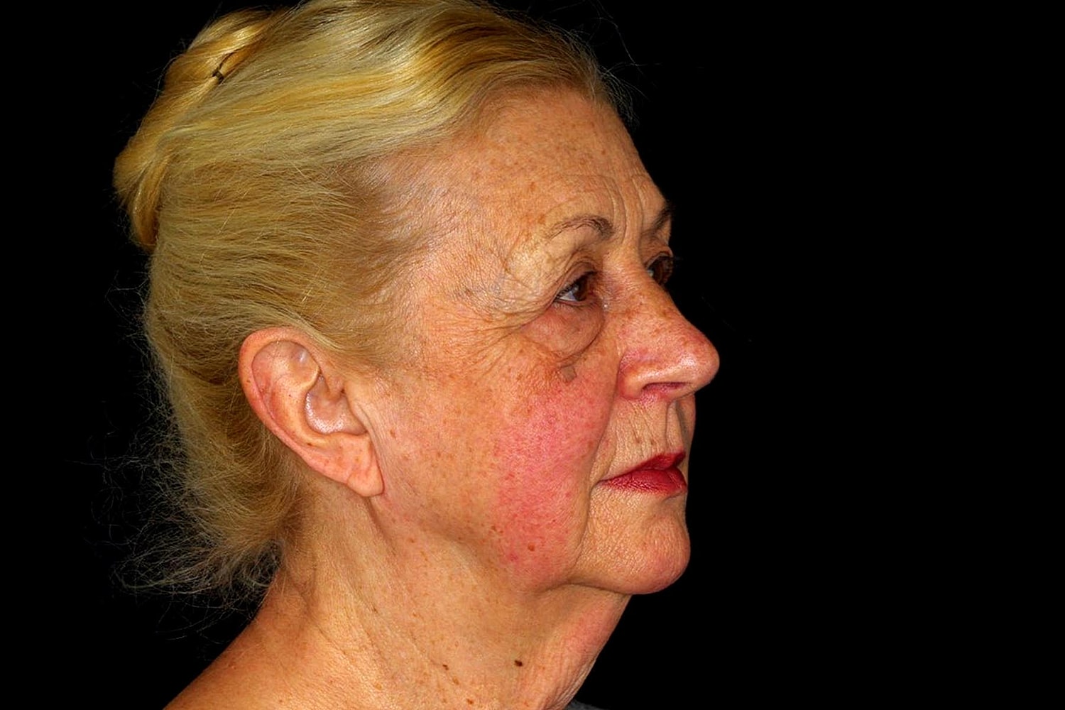 Facelift Before & After