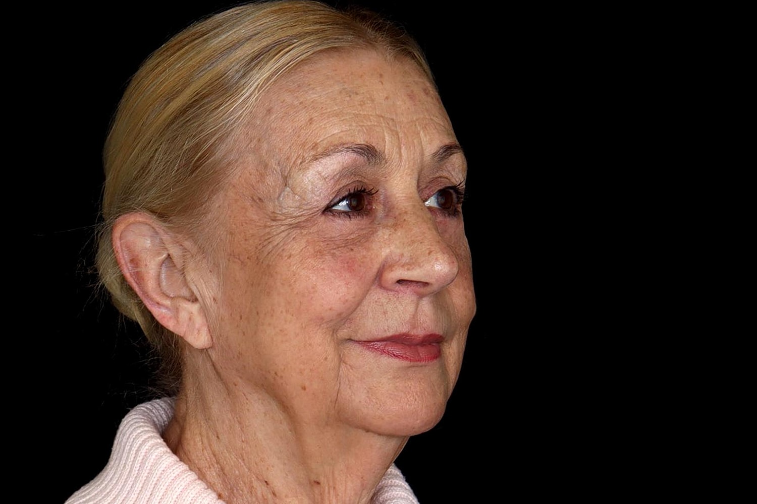 Facelift Before & After