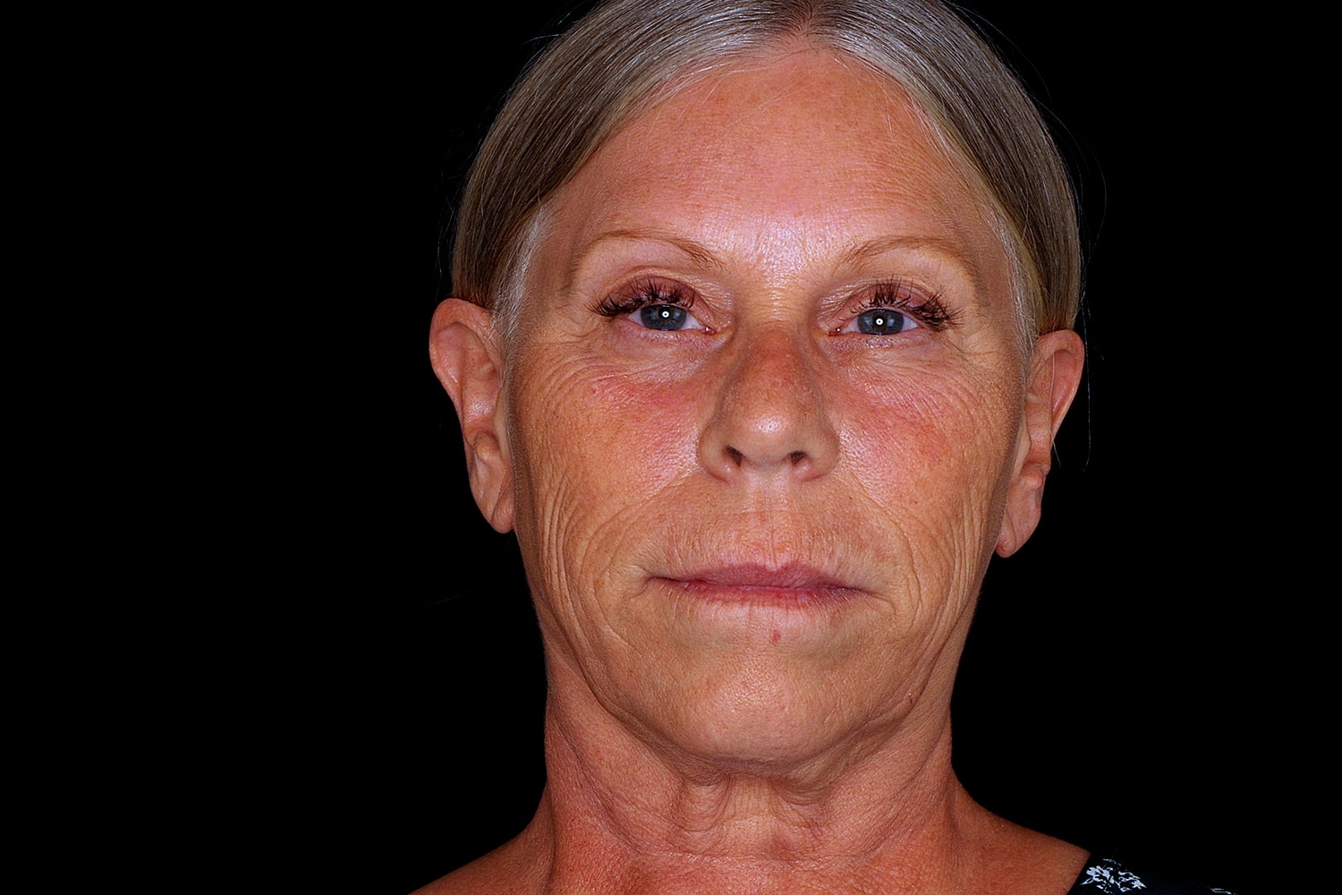 Facelift Before & After