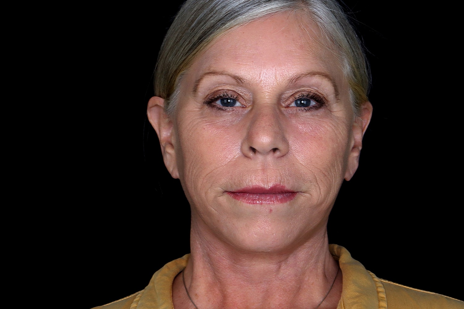 Facelift Before & After