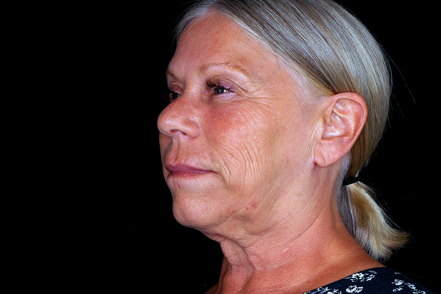 Facelift Before & After